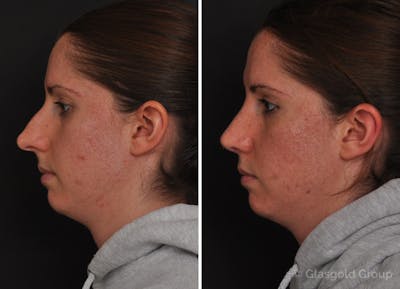 Rhinoplasty Before & After Gallery - Patient 268131 - Image 1