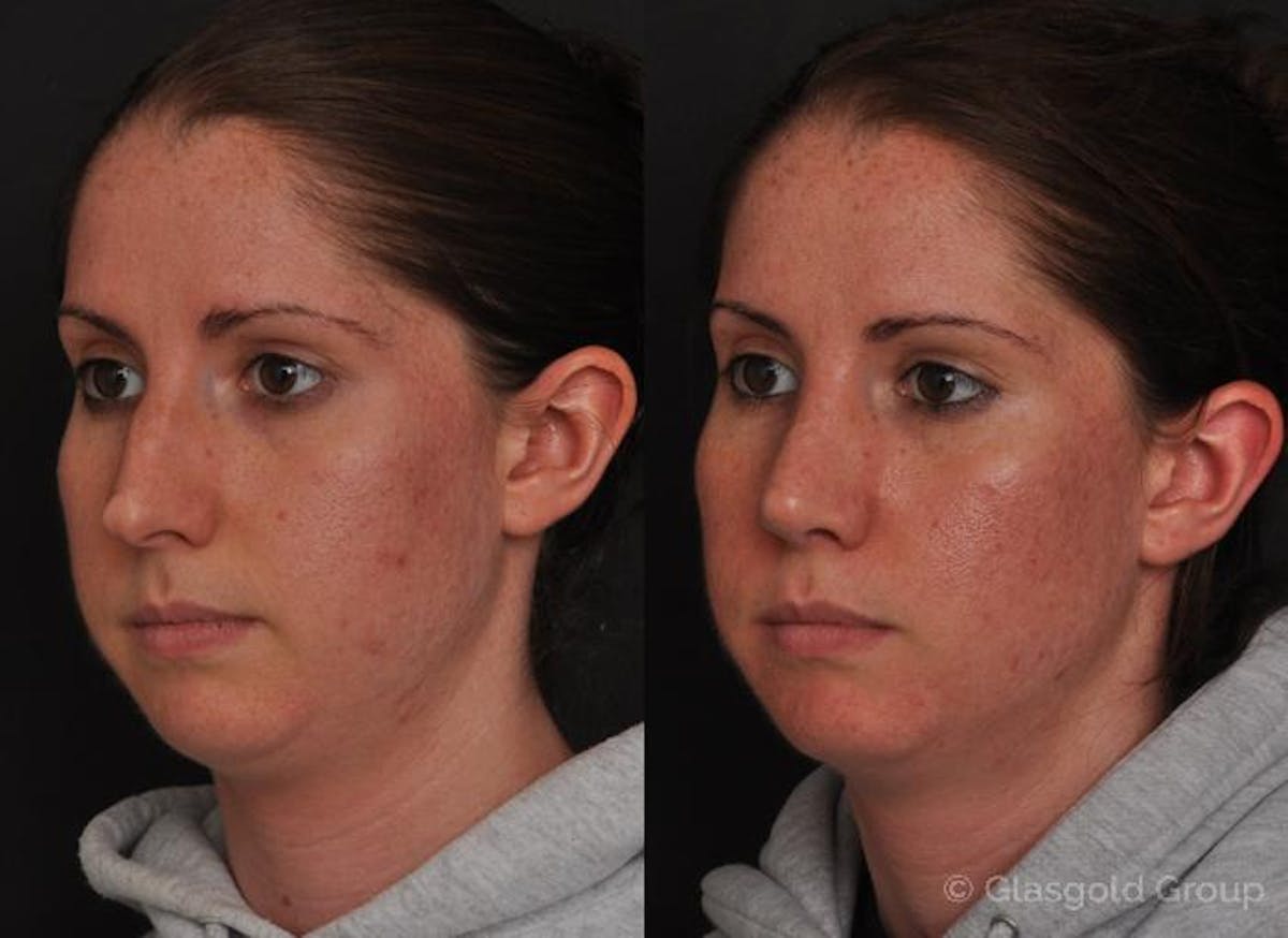 Rhinoplasty Before & After Gallery - Patient 268131 - Image 3