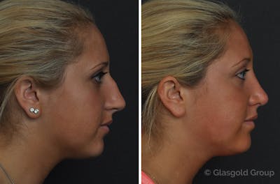 Rhinoplasty Before & After Gallery - Patient 417755 - Image 1