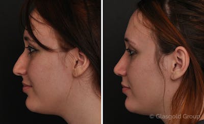Rhinoplasty Before & After Gallery - Patient 149078 - Image 1