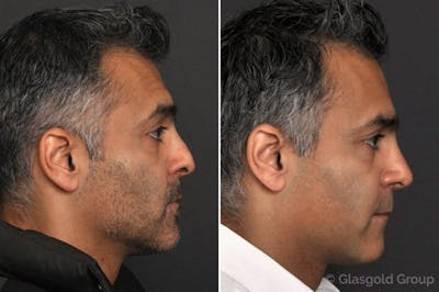 Rhinoplasty Before & After Gallery - Patient 247795 - Image 1
