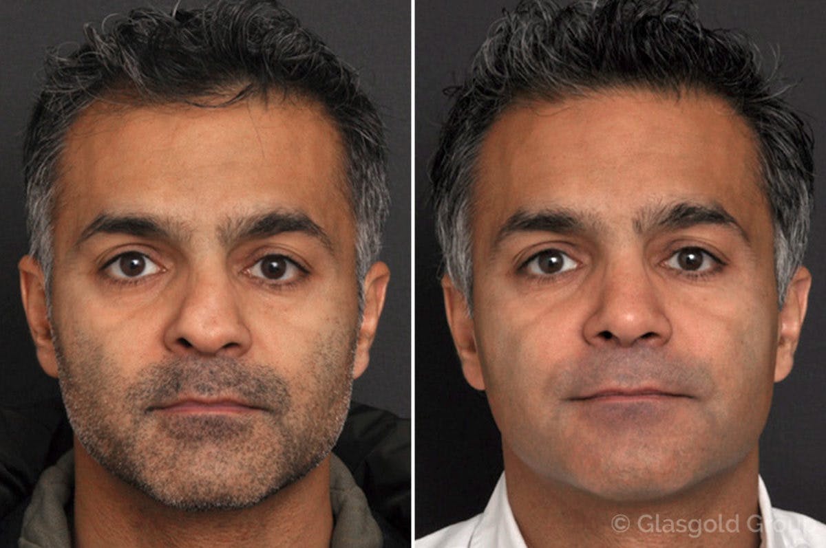 Rhinoplasty Before & After Gallery - Patient 247795 - Image 2