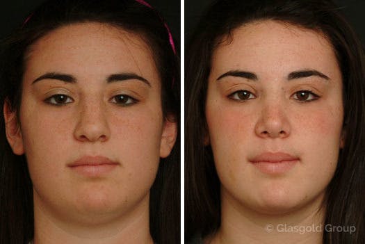 Rhinoplasty Before & After Gallery - Patient 102306 - Image 2