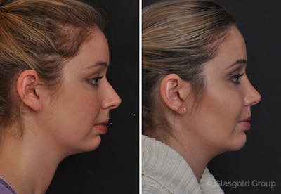 Rhinoplasty Before & After Gallery - Patient 820305 - Image 1