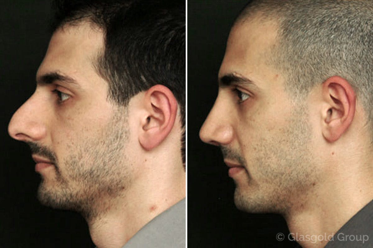 Rhinoplasty Before & After Gallery - Patient 113303 - Image 1