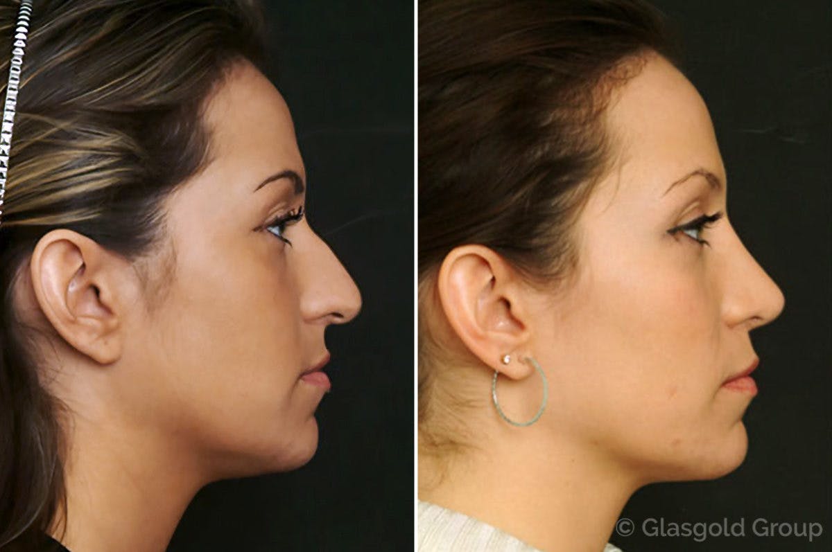 Rhinoplasty Before & After Gallery - Patient 165367 - Image 1