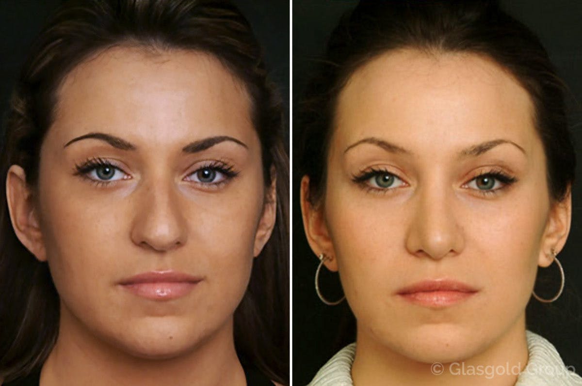 Rhinoplasty Before & After Gallery - Patient 165367 - Image 2