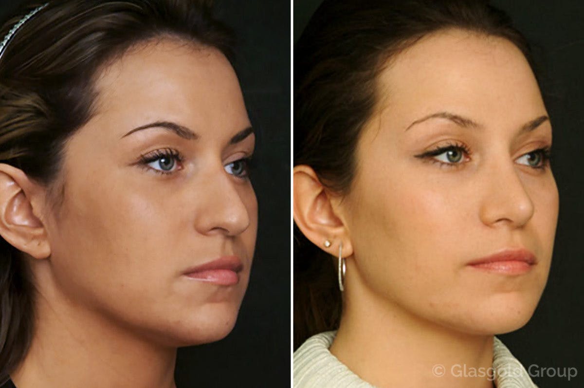 Rhinoplasty Before & After Gallery - Patient 165367 - Image 3