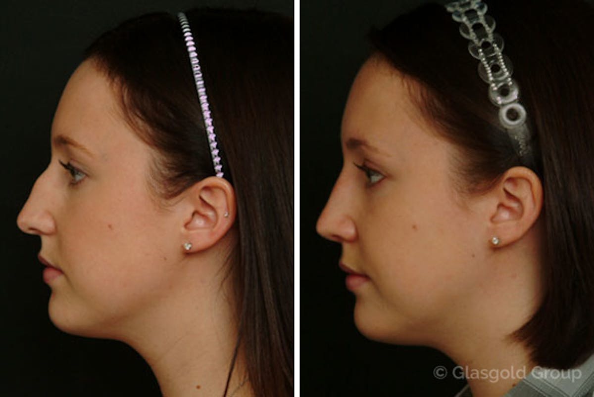 Rhinoplasty Before & After Gallery - Patient 110947 - Image 1
