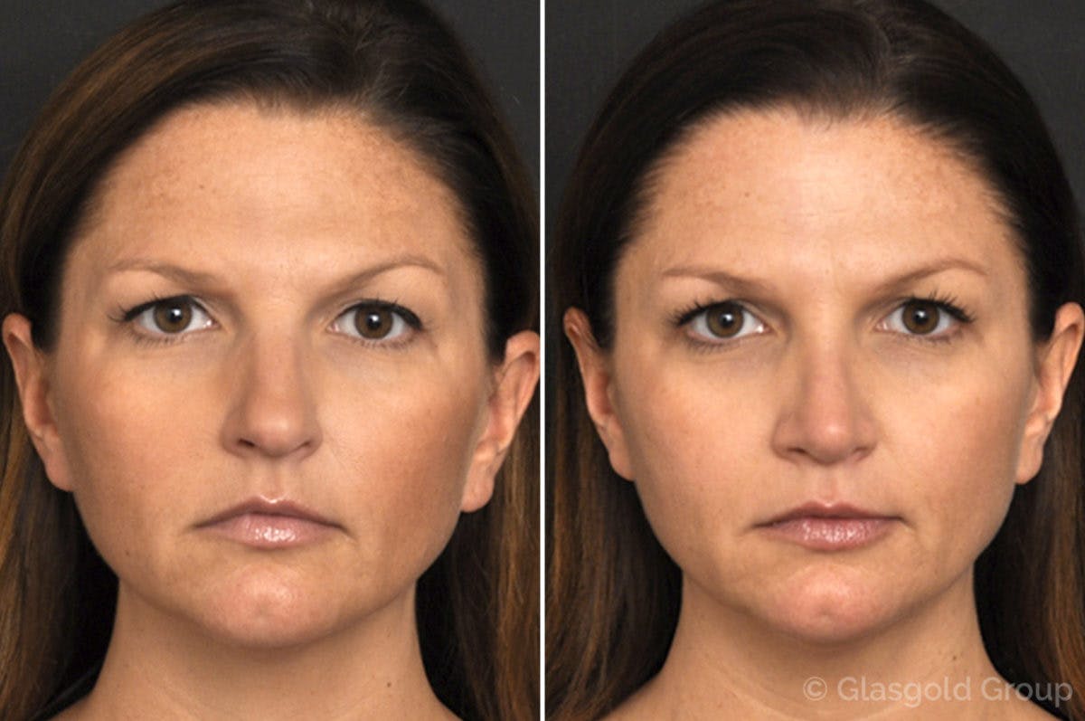 Rhinoplasty Before & After Gallery - Patient 297140 - Image 2