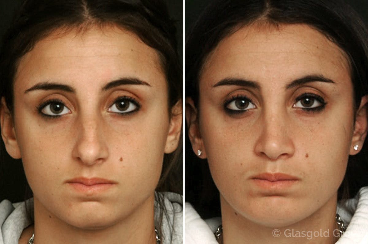 Rhinoplasty Before & After Gallery - Patient 390334 - Image 2