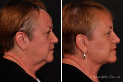 Rhinoplasty Before & After Gallery - Patient 318588 - Image 1