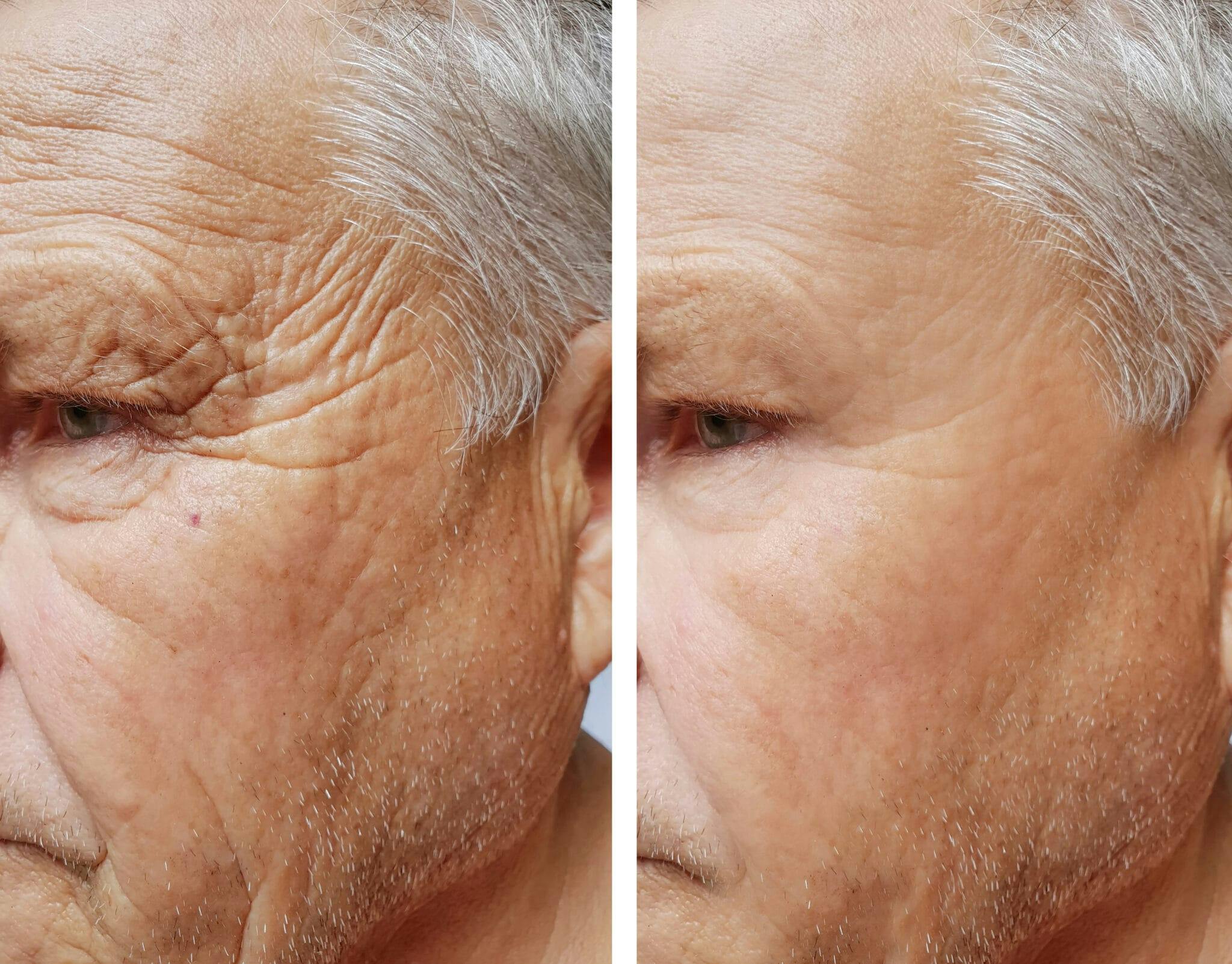 facial rejuvenation before and after