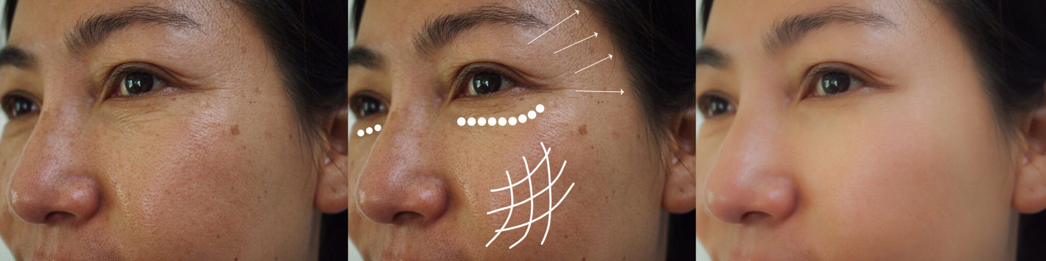 facial rejuvenation patient results