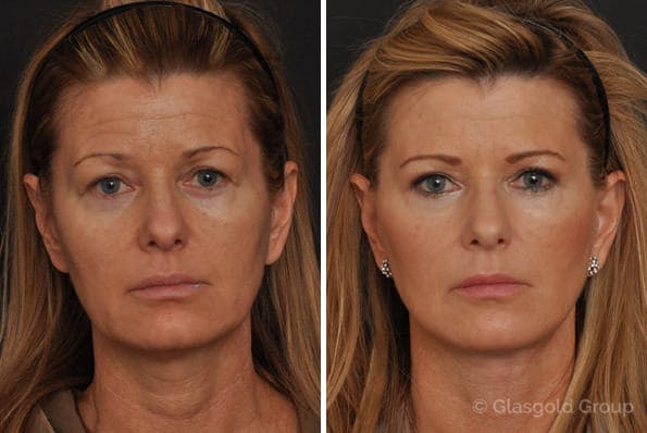 facelift before and after