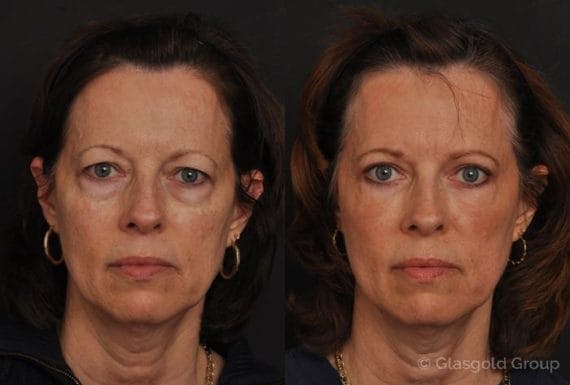 Facial Fat Transfer before and after
