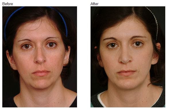 Neck Liposuction before and after