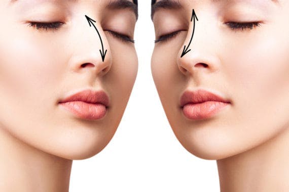How to Prepare for Rhinoplasty