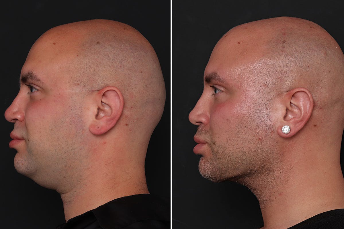 Male Necklift Before & After Gallery - Patient 206012 - Image 3