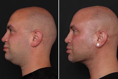 Male Necklift Before & After Gallery - Patient 206012 - Image 1
