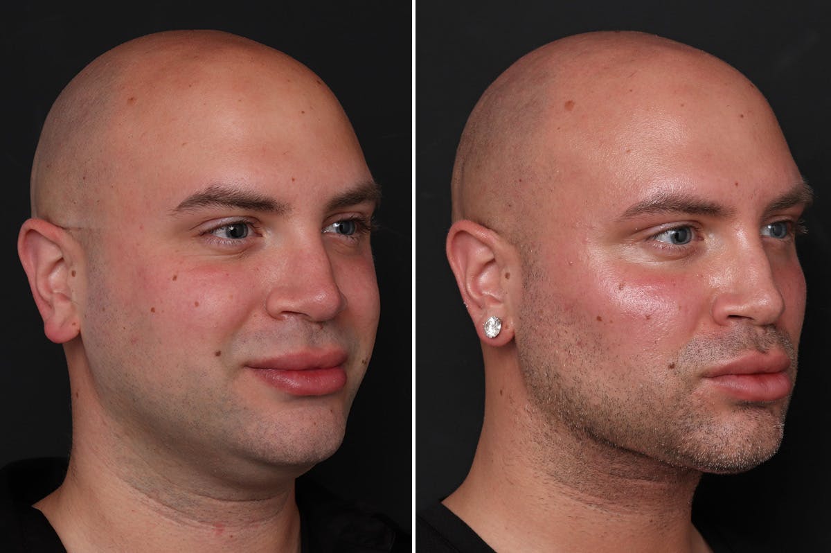 Male Necklift Before & After Gallery - Patient 206012 - Image 2