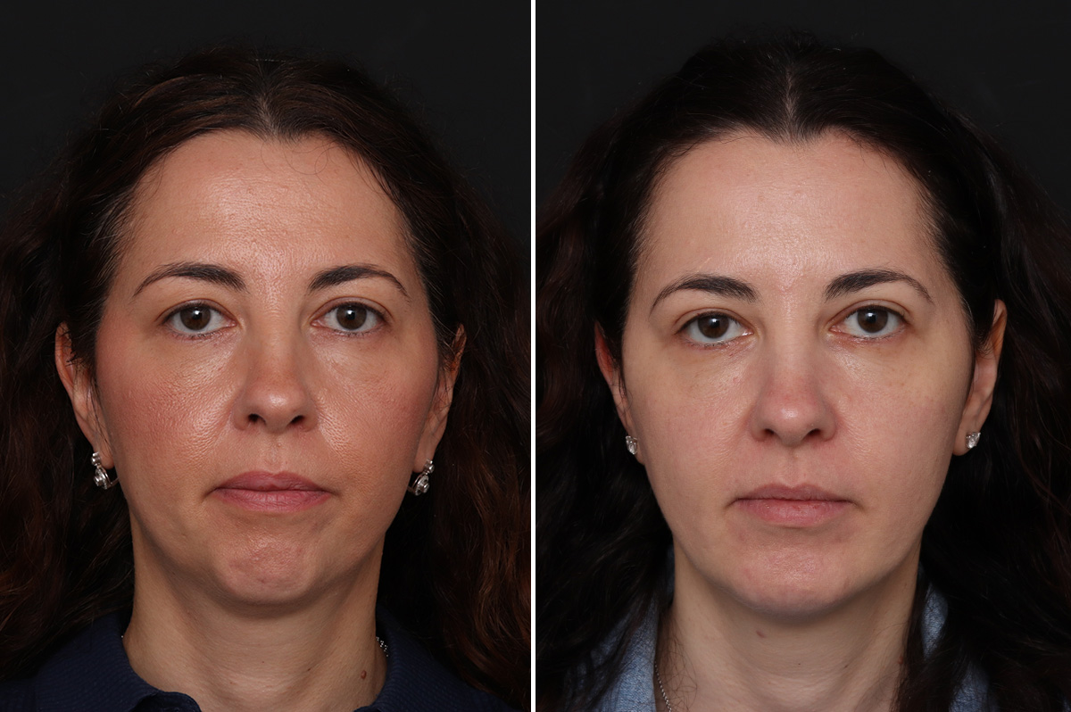 Blepharoplasty (Eyelid Surgery) in New Jersey | Glasgold Blepharoplasty (Eyelid Surgery) in New Jersey | Glasgold