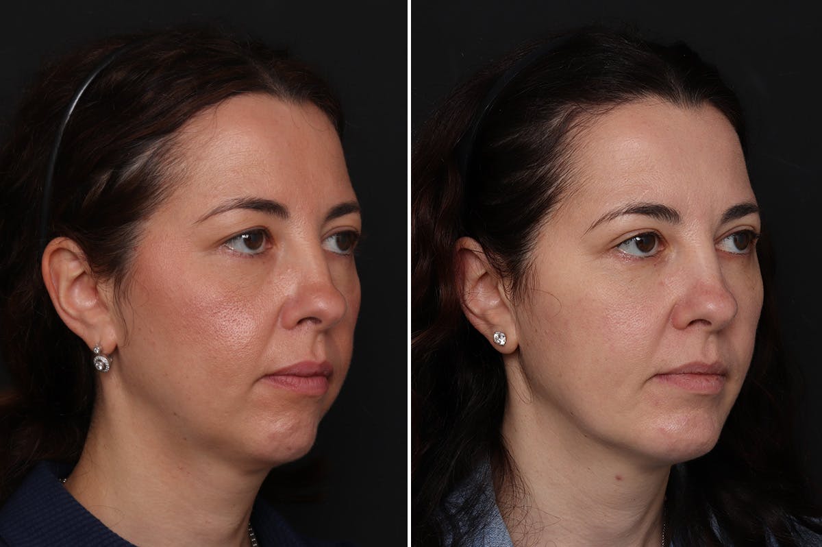 Fat Transfer Before & After Gallery - Patient 906769 - Image 2