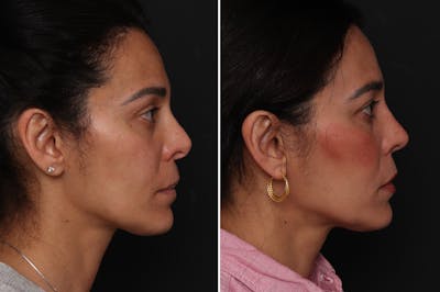 Revision Rhinoplasty Before & After Gallery - Patient 584849 - Image 1