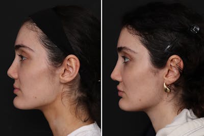 Revision Rhinoplasty Before & After Gallery - Patient 151401 - Image 1