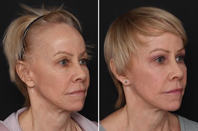 Fat Transfer Before & After Gallery - Patient 167544 - Image 1