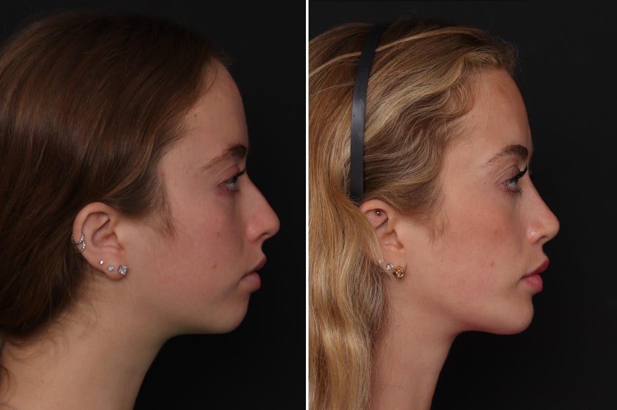 Chin Implants Before & After Gallery - Patient 338047 - Image 1