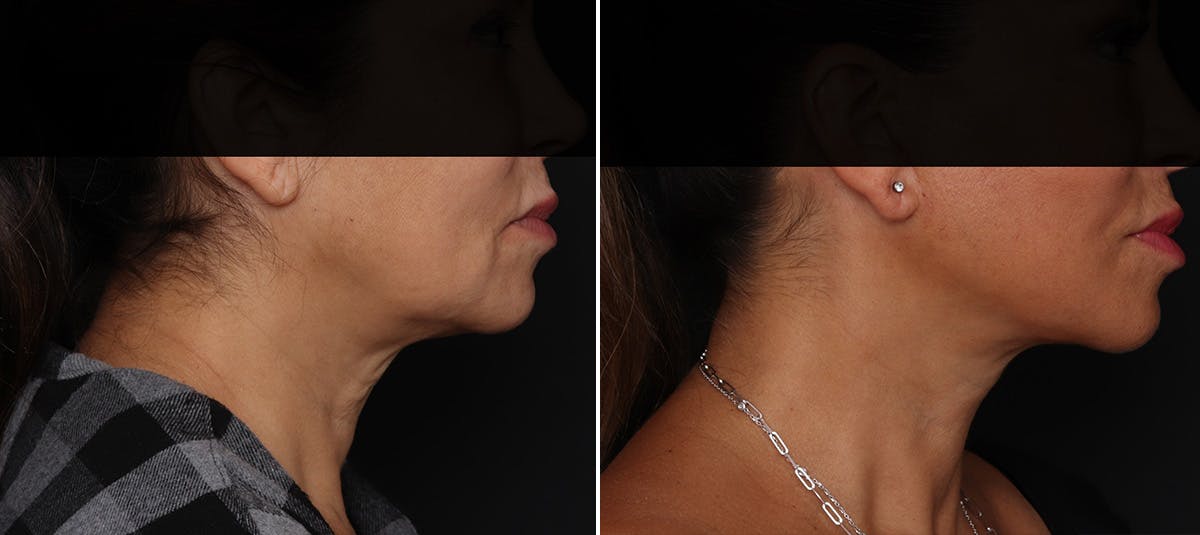 Facelift Before & After Gallery - Patient 228489 - Image 2