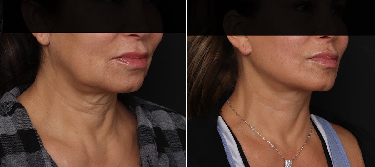 Facelift Before & After Gallery - Patient 228489 - Image 1