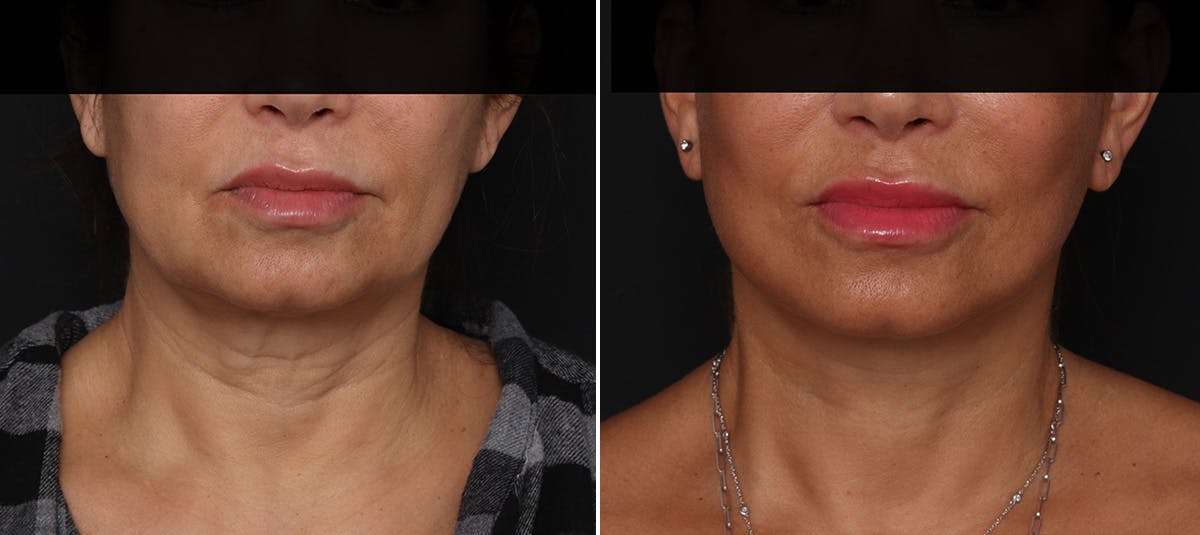 Facelift Before & After Gallery - Patient 228489 - Image 3