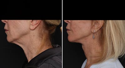 Facelift Before & After Gallery - Patient 168583 - Image 1