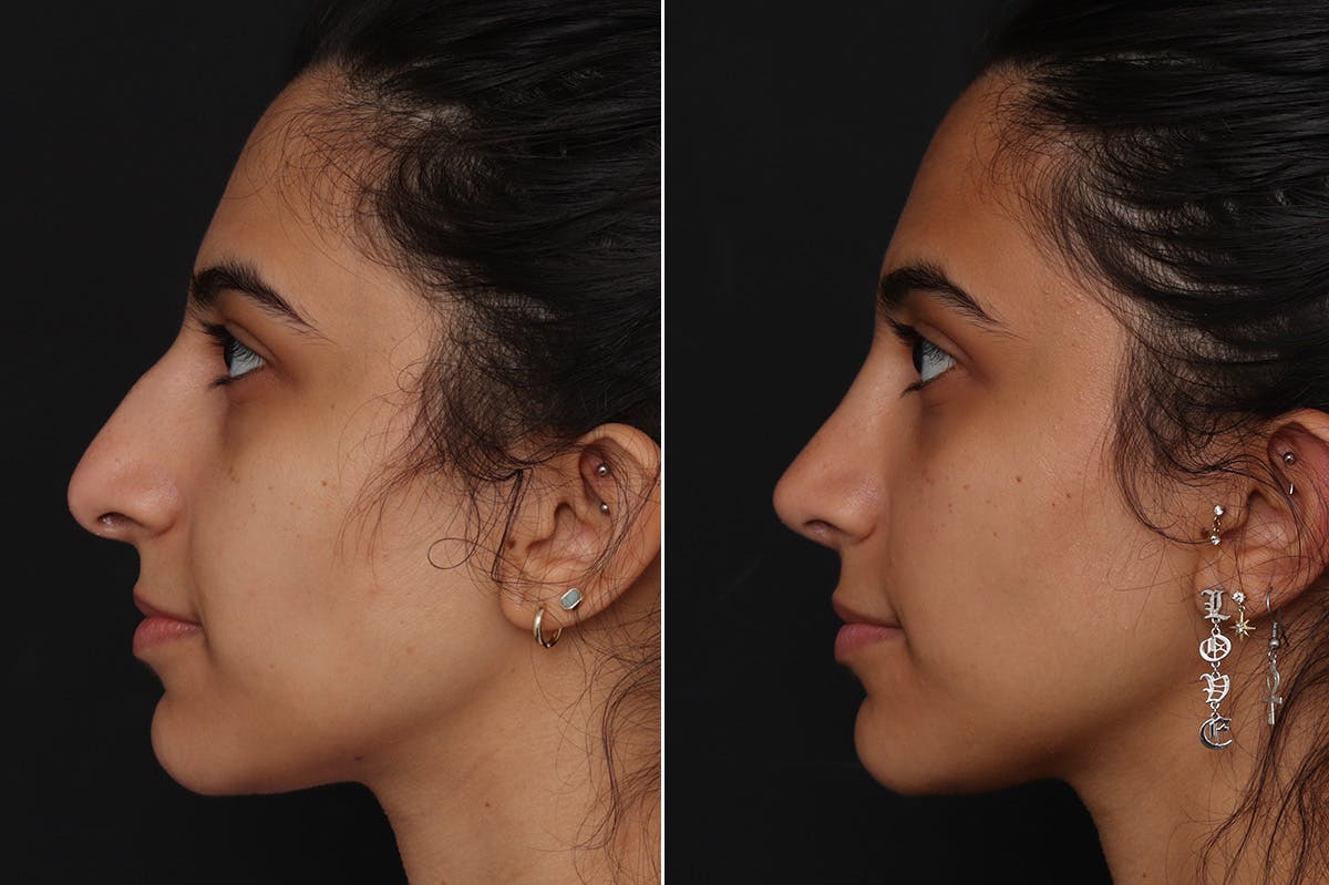 Rhinoplasty Before & After Gallery - Patient 111945 - Image 1