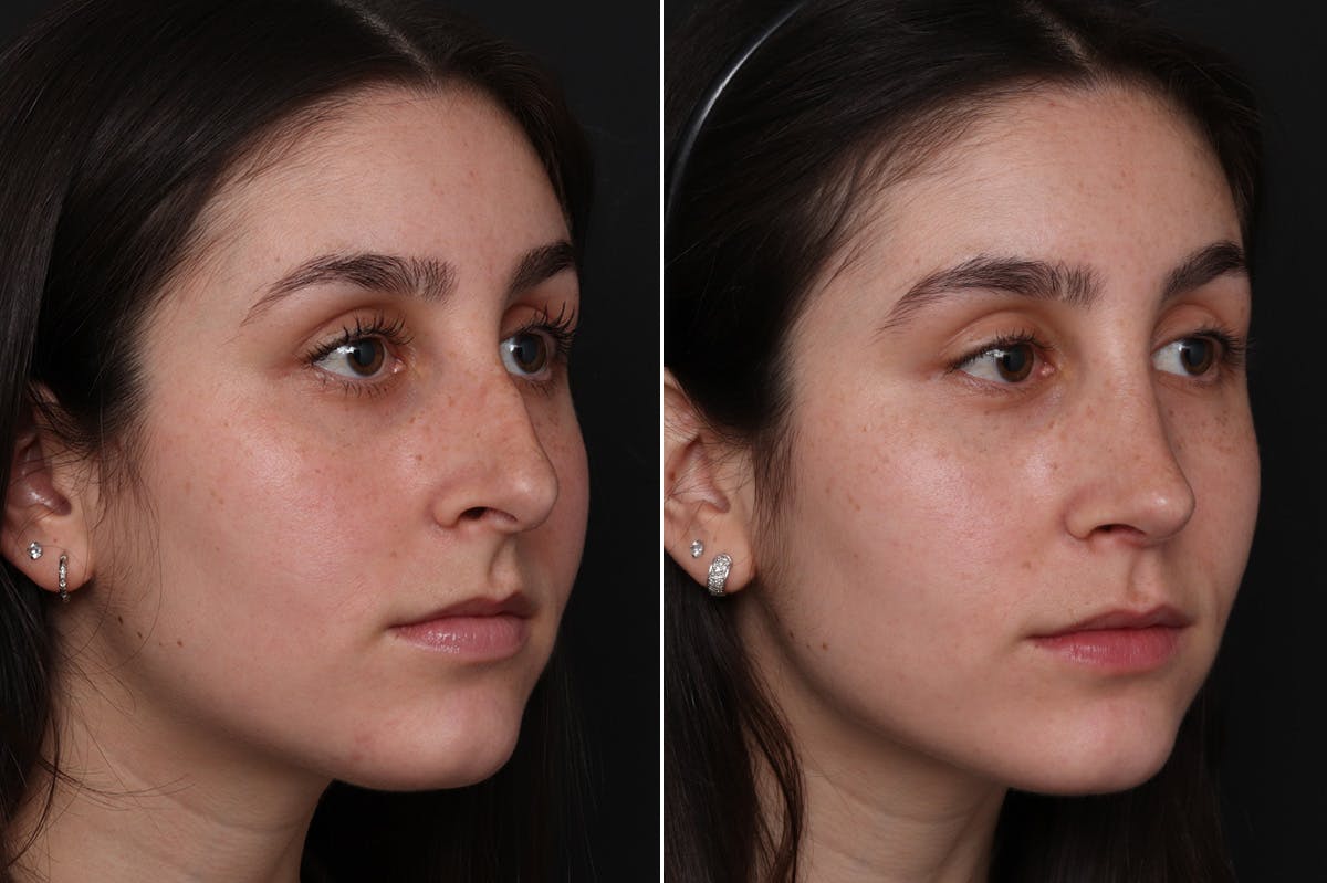 Rhinoplasty Before & After Gallery - Patient 248716 - Image 2