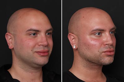 Buccal Fat Removal Before & After Gallery - Patient 190319 - Image 1