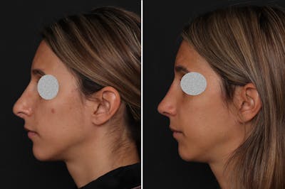Revision Rhinoplasty Before & After Gallery - Patient 201619 - Image 1