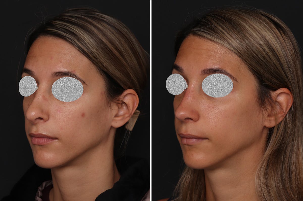 Revision Rhinoplasty Before & After Gallery - Patient 201619 - Image 2