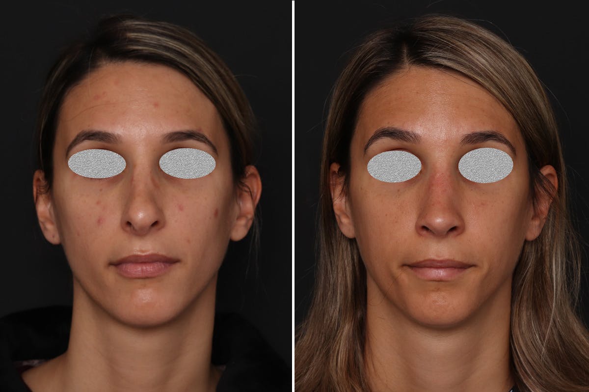 Revision Rhinoplasty Before & After Gallery - Patient 201619 - Image 3