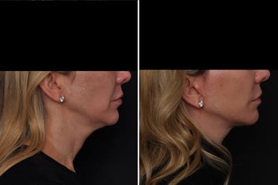 Facelift Before & After Gallery - Patient 356446 - Image 1
