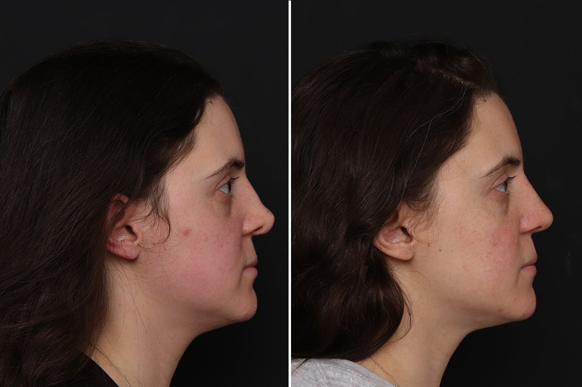 Revision Rhinoplasty Before & After Gallery - Patient 182153 - Image 2