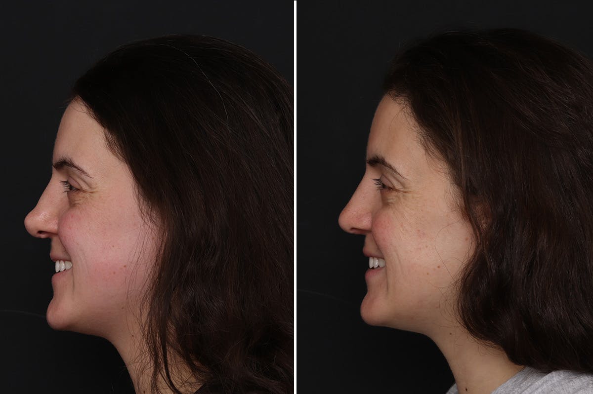 Revision Rhinoplasty Before & After Gallery - Patient 182153 - Image 1