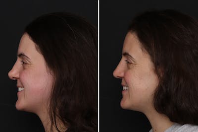 Revision Rhinoplasty Before & After Gallery - Patient 182153 - Image 1