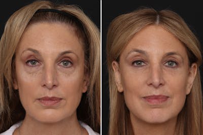 Lower Eyelid Before & After Gallery - Patient 108095 - Image 1