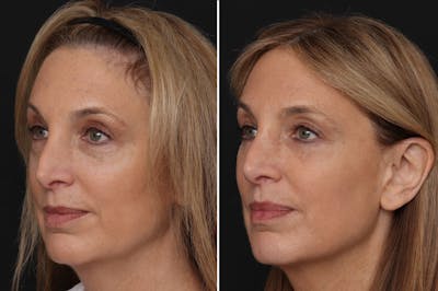 Lower Eyelid Before & After Gallery - Patient 108095 - Image 1