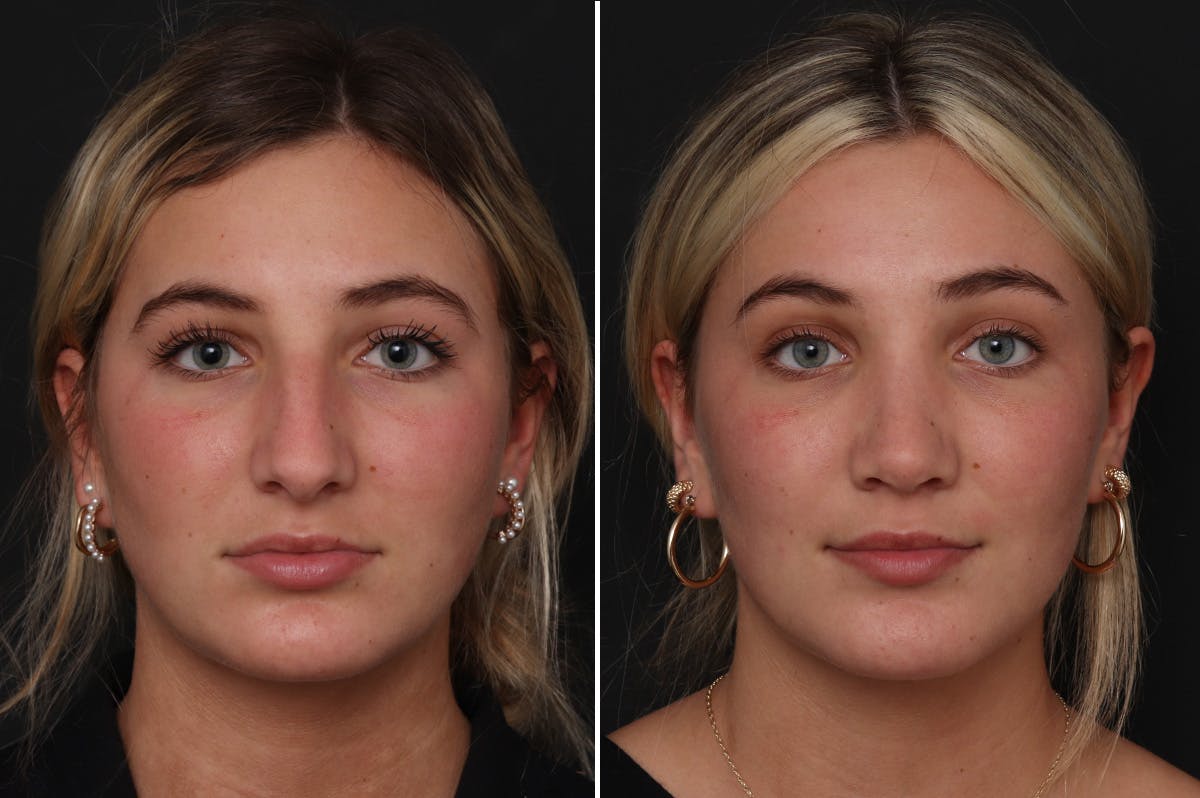 Rhinoplasty Before & After Gallery - Patient 277079 - Image 3