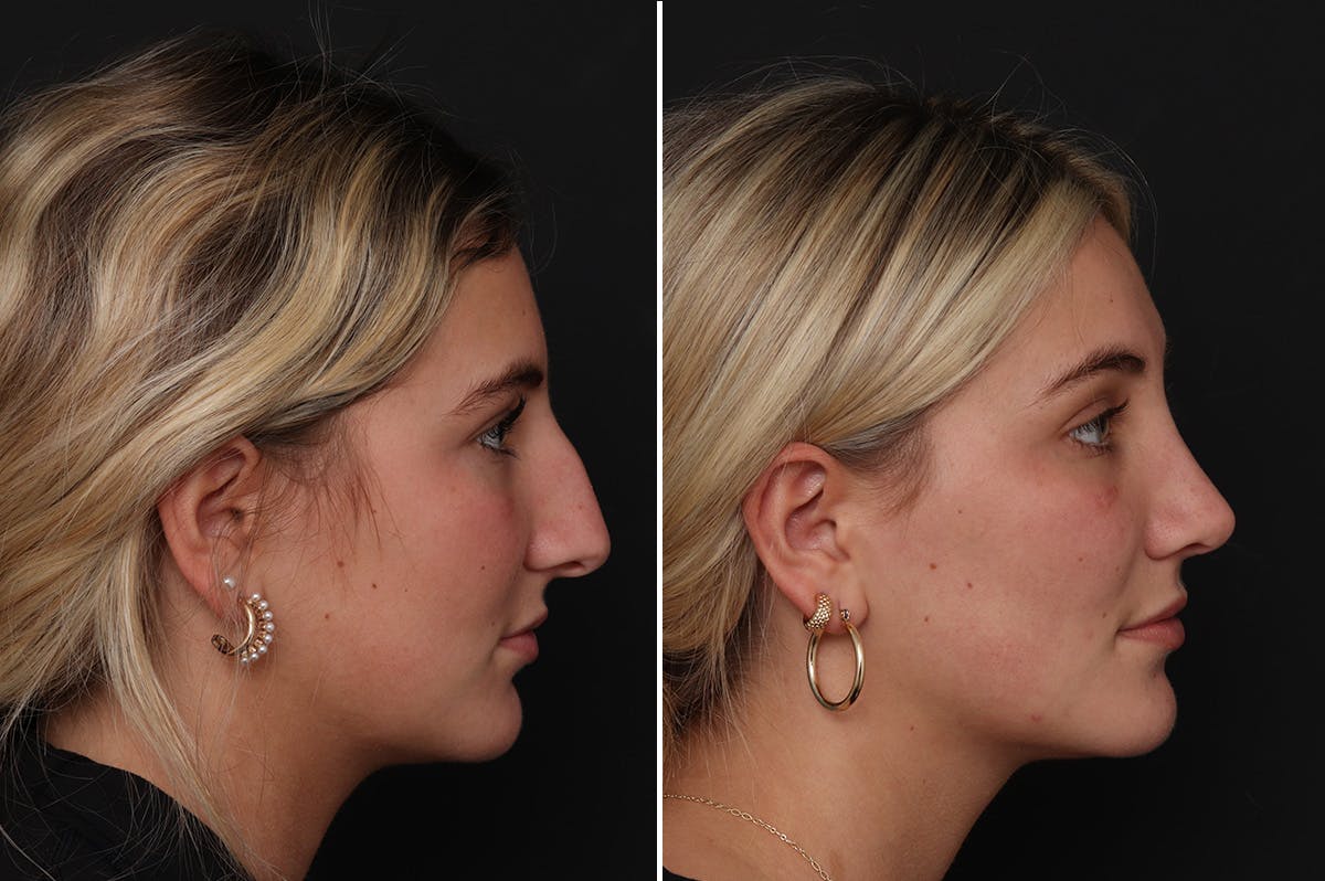 Rhinoplasty Before & After Gallery - Patient 277079 - Image 1