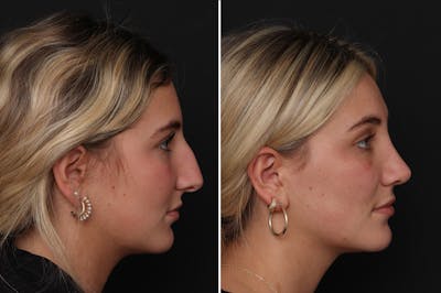 Rhinoplasty Before & After Gallery - Patient 277079 - Image 1